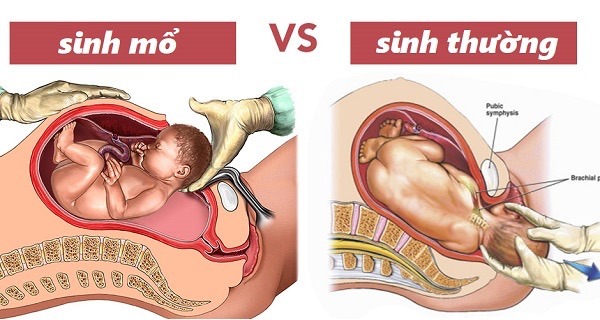 sinh con tự nhiên